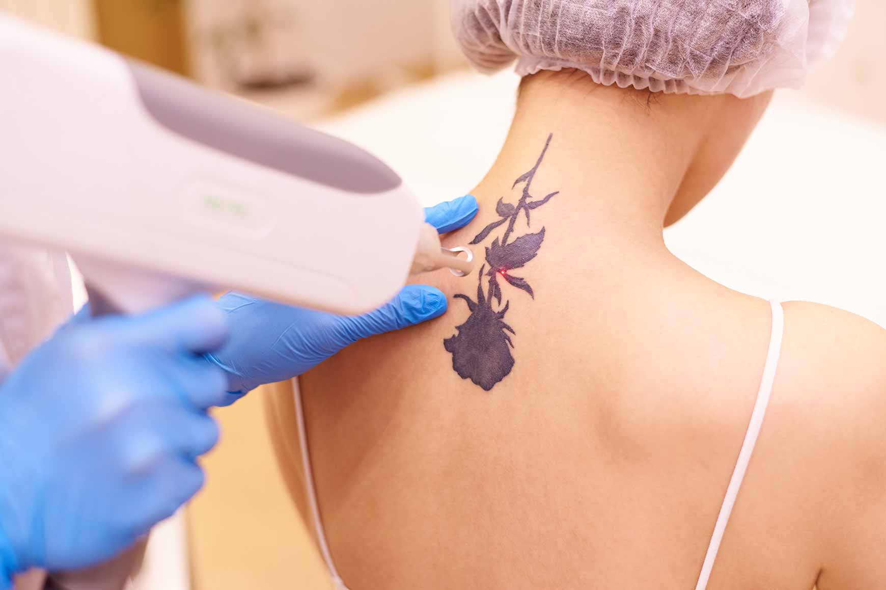 Get your tattoo removed safely with our laser treatment