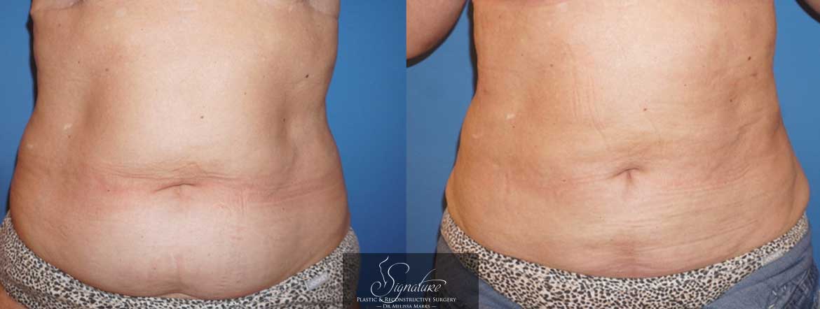 Abdomen and flank liposuction - before and after