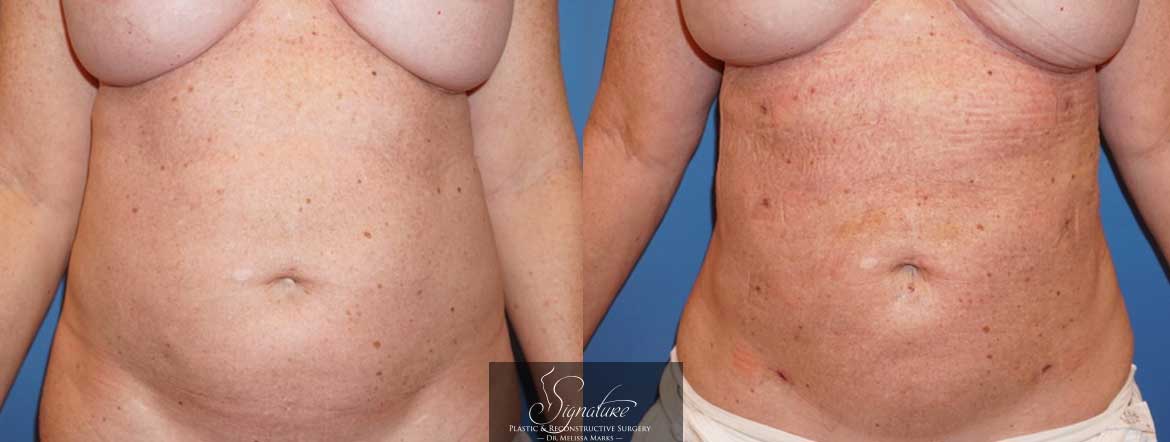 Flank and abdomen liposuction before and after