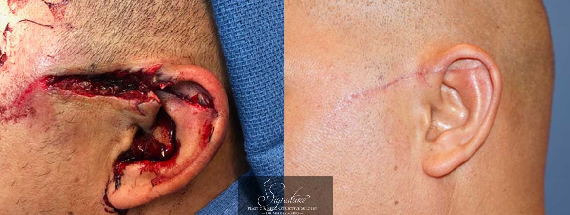 Dr. Melissa Marks - Traumatic Face & Ear Injury