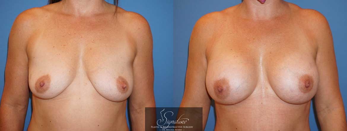 Breast Augmentation - By Dr. Melissa Marks