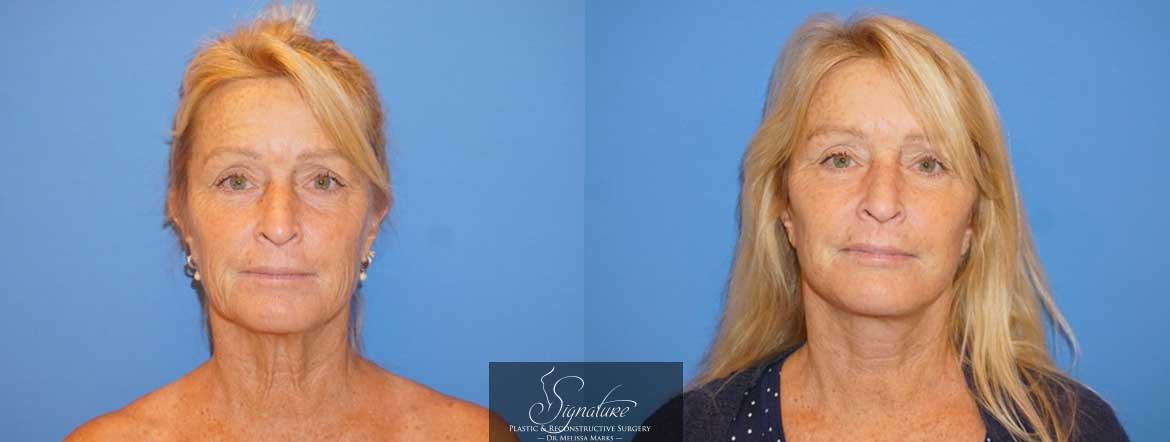 Face and Neck Lift - Dr. Melissa Marks